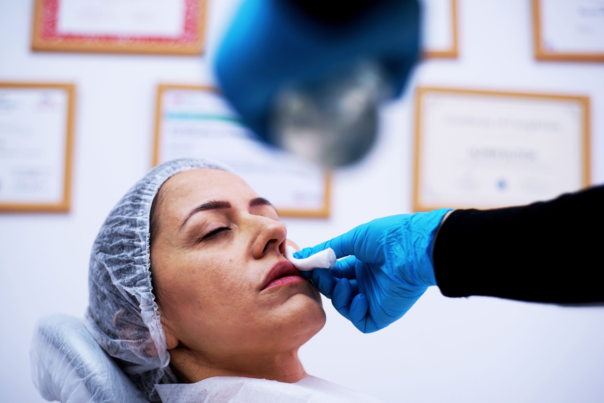 Facial aesthetics surgery treatment stock photo